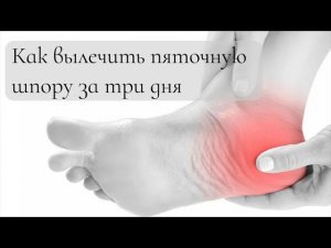 Как вылечить пяточную шпору за три дня