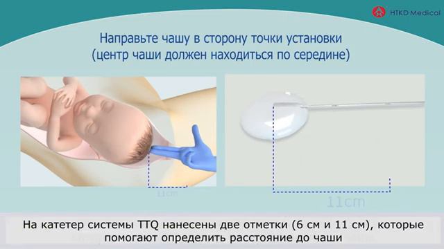 Использование TTQ смотреть онлайн