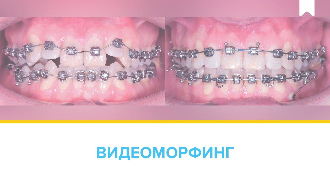 Лечение скученности без удаления у 44-летнего пациента индивидуальными цифровыми брекетами INSIGNIA