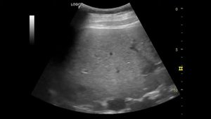 Метастазы в печени