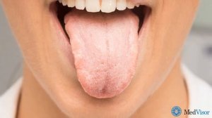 Почему возникает ощущение соли во рту