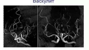 Интракраниальные опухоли, рассеянный склероз и другие поражения белого вещества головного мозга