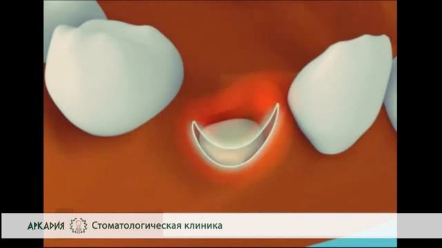 Альвеолит