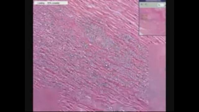 Гистология острого инфаркта миокарда