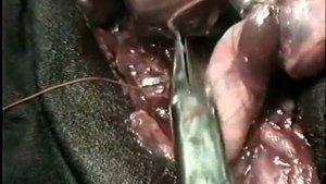 Пластика пахового канала по методу Шоулдайса © Plastic inguinal canal on Shouldaysa method