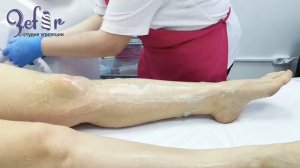 Как делают лазерную эпиляцию.