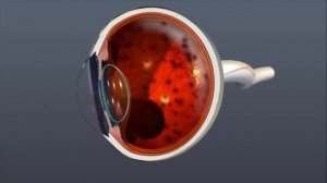 Диабетическая ретинопатия