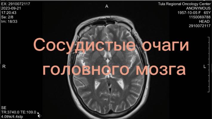 МРТ головного мозга. Сосудистые очаги. Разбор случая с пояснениями врача МРТ.