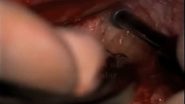 Transmastoid labyrinthectomy смотреть онлайн