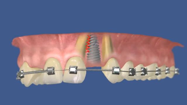 Ортодонтия Ортодонтическое смещение двух зубов с последующей имплантацией смотреть онлайн