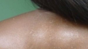 ХИРУРГ не поверил, но я ИЗБАВИЛСЯ от ЖИРОВИКА обычным... Это есть у всех дома #папилома