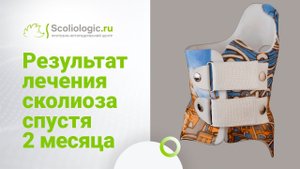 Корсет Шено. Лечение сколиоза 3-ей степени у девочки-подростка.