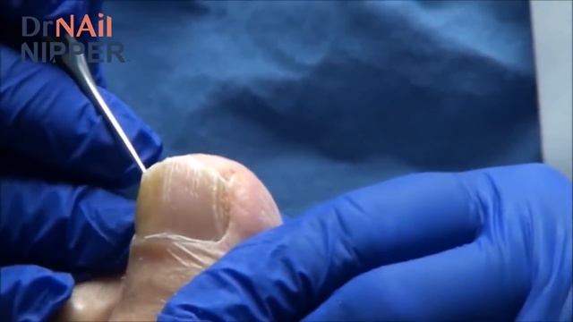 Cancer Doc Toes and Toenails [Throwback Thursday] смотреть онлайн