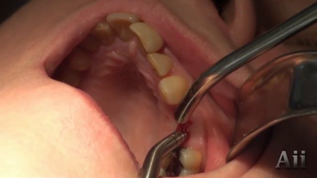 Osteotome Sinus Lift смотреть онлайн