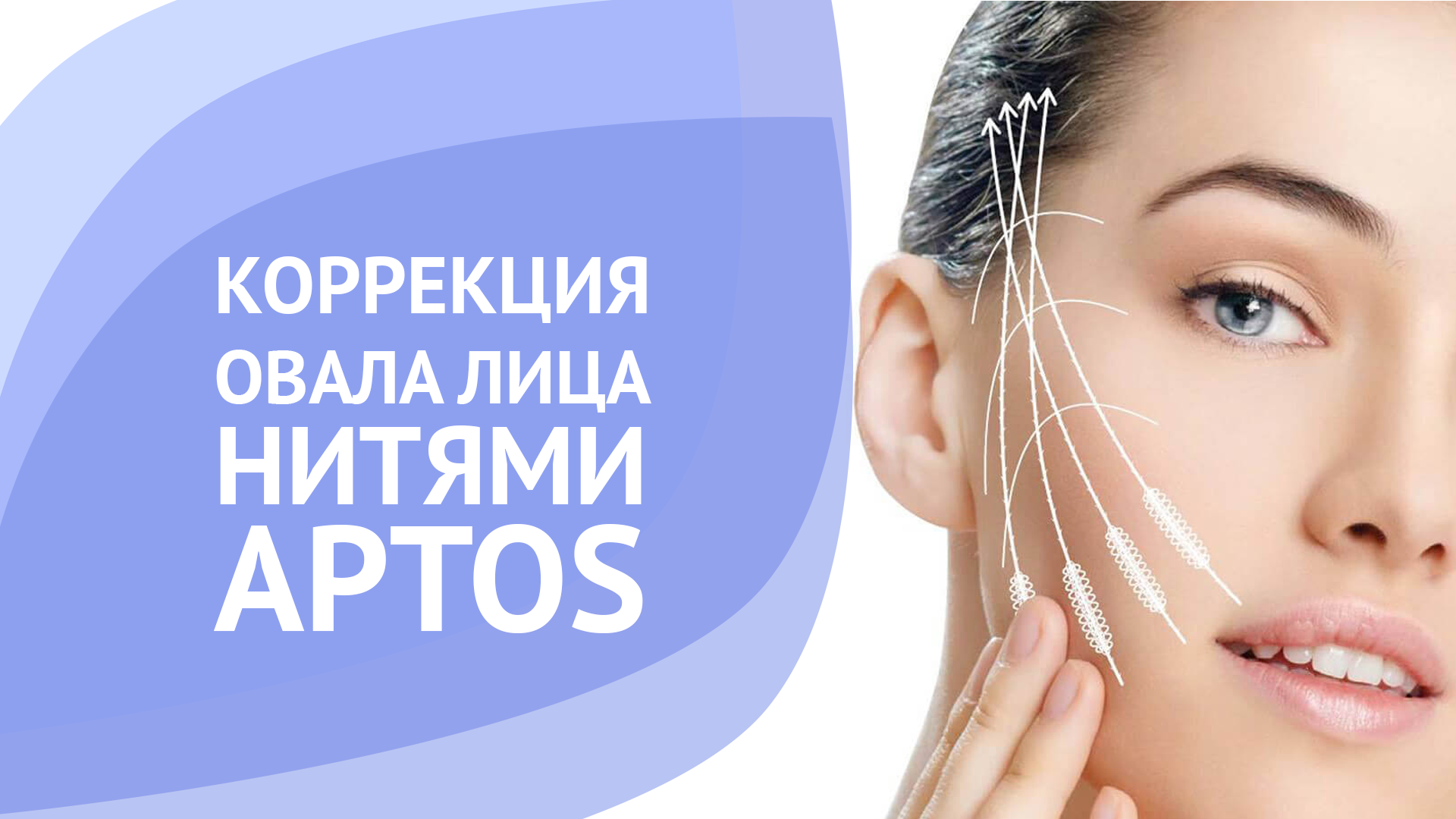 Коррекция овала лица нитями Aptos