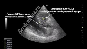 ЭхоКГ. Обструкция выходного отдела левого желудочка при гипертрофической кардиомиопатии (ГКМП)