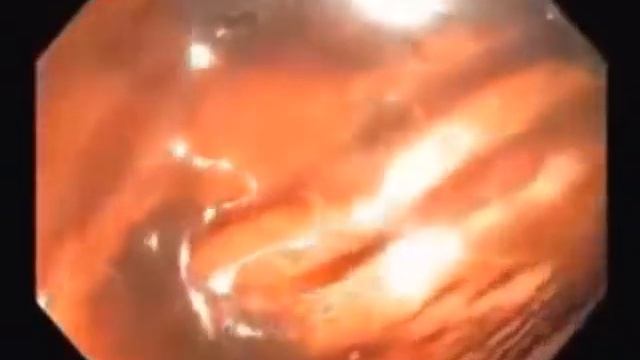 Кишечник загрязненный: как выглядит, что будет с организмом если его не чистить, не заботится о нём