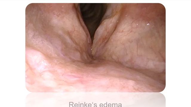 «Современный взгляд на лазерную хирургию в оториноларингологии в России и Европе». Часть 2 смотреть онлайн