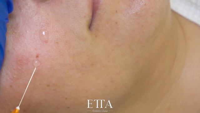 IO PRC PEELING смотреть онлайн