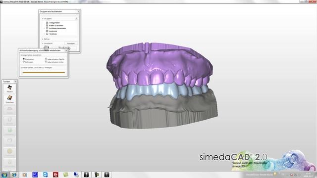 simedaCAD (exoCAD) Bitesplint Virtual Articulator