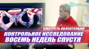 Контрольное исследование восемь недель спустя (смотреть обязательно) #лечениеракапростаты