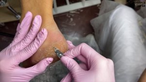 Гиперкератоз?/ Работа с пяткой