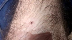 Как вытащить клеща обычной нитью