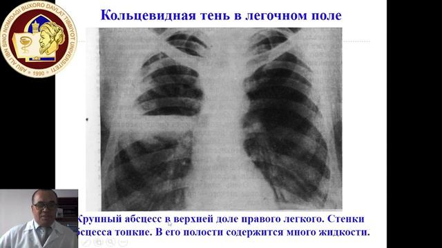 Рентгенограмма легких.