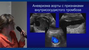 Ультразвуковое исследование в диагностике аневризмы брюшного отдела аорты, Саратова А.К.