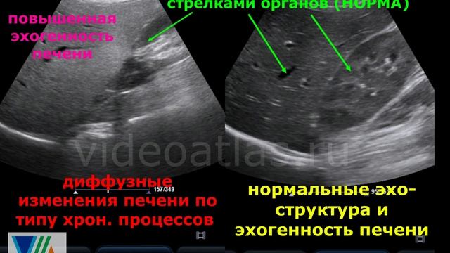 Диффузные изменения синуса обеих почек. Гепатомегалия диффузные изменения печени. Умеренно выраженные диффузные изменения печени. Диффузионные изменения печени и поджелудочной железы. Диффузные изменения в поджелудочной железе.