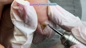 СИНЕГНОЙНАЯ ПАЛОЧКА. ГРИБОК НОГТЕЙ? ПОЧЕМУ НОГОТЬ СТАЛ ЗЕЛЕНЫМ. ОНИХОЛИЗИС. Pseudomonas aeruginosa