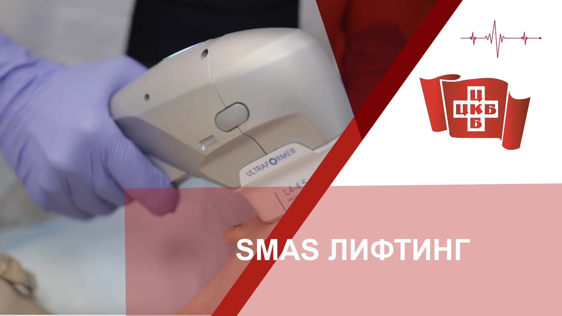 SMAS ЛИФТИНГ