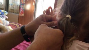 Как снять медицинскую сережку Пуссет гвоздик, пример на ребёнке с помощью маникюрных ножниц!