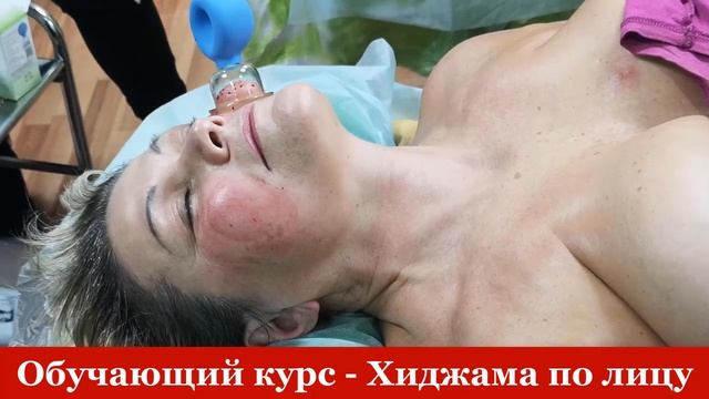 Хиджама по лицу. Обучение - ускоренная программа.