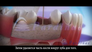 Удлинение зубные коронки ©