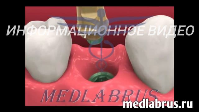 Имплантация зубов
