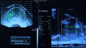 Фьюжн-биопсия простаты. Мнение эксперта