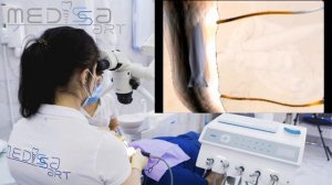 Пломбирование корневого канала системой BeeFill