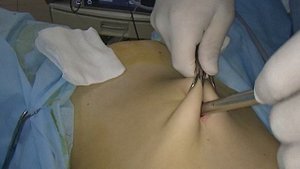 вход в брюшную полость // первый троакар
