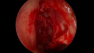 Maxillary Antrostomy-  dr. Suresh Singh Naruka & dr. Maksat Talaibekov