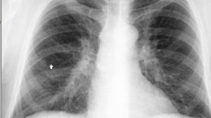 Расшифровка. Гамартома легкого.