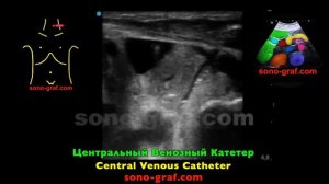 УЗИ - Центральный Венозный Катетер