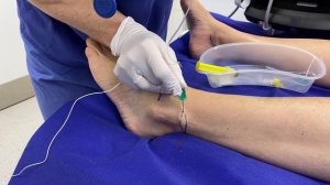 Sural nerve block at foot level. Блокада икроножного нерва на уровне стопы,