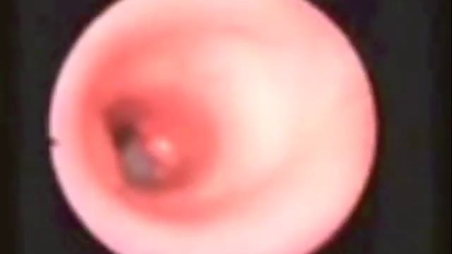 Стенозы трахеи и гортани после интубации и трахеостомии А.С.Горячев смотреть онлайн