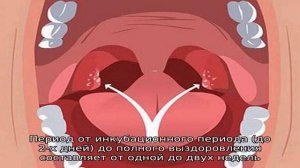 Чем отличается лакунарная ангина от фолликулярной?