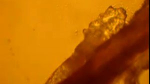 Демодекоз видео: клещ демодекс под микроскопом