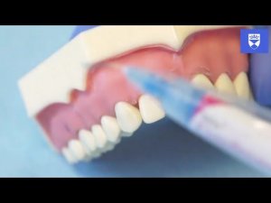 Шинирование центрального резца верхней челюсти