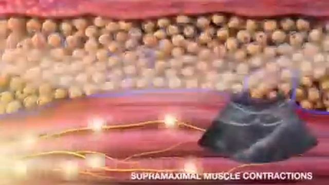 sincoheren Принцип действия аппарата электромагнитной стимуляции мышц смотреть онлайн