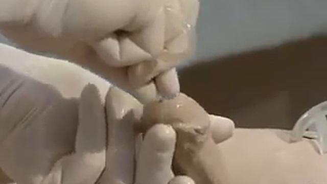 Катетеризация мочевого пузыря катетером Фолея смотреть онлайн