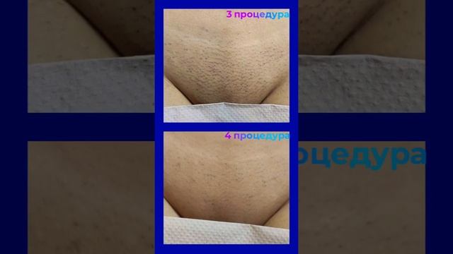 Лазерная эпиляция, результаты лазерной эпиляции